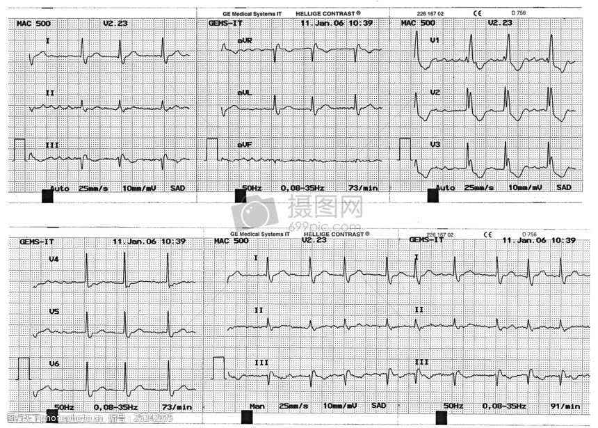 关键词:心脏的心电图显示 波浪线 心电图 医生 医院     红色 jpg